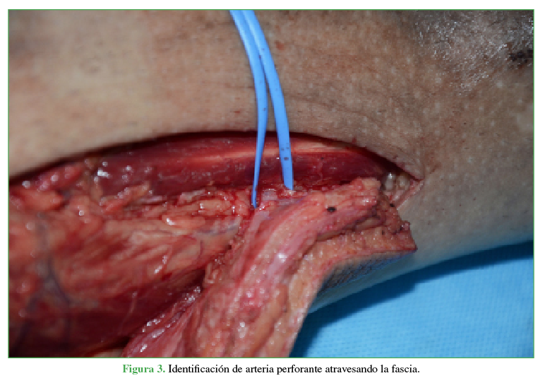 Identficación de la arteria perforante atravesando la fascia.