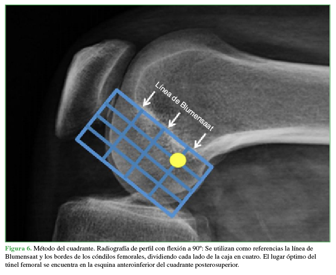Método del cuadrante. Radiografía de perfil con flexión a 90°