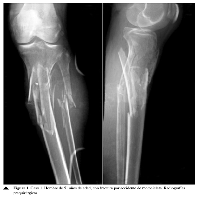 Hombre de 51 años de edad, con fractura por accidente de motocicleta. Radiografías prequirúrgicas