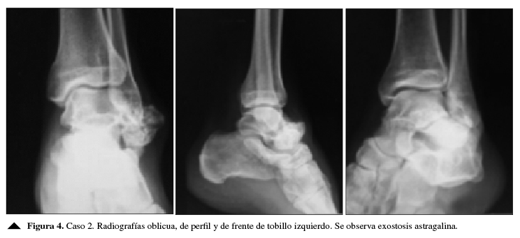 Caso 2.Radiografías oblicua, de perfil y de frente de tobillo izquierdo.