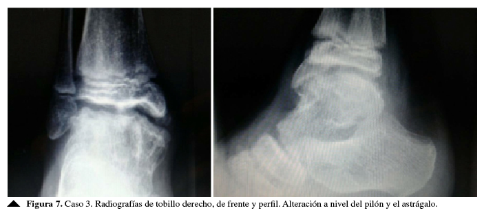 Caso 3. Radiografías de tobillo derecho, de frente y de prfil.