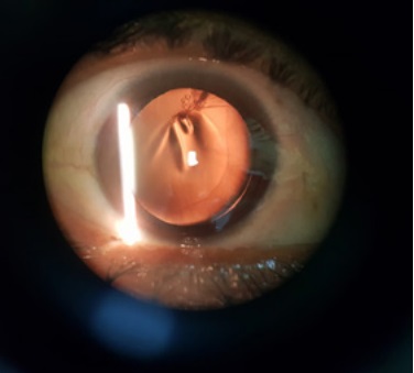 Examen biomicroscópico de segmento anterior bajo midriasis
medicamentosa. 
