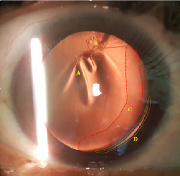 Biomicroscopy
by retroillumination (OD): A: folds in the anterior capsule + capsular fibrosis
in situ. B: traumatic cataract in progress. C: vitreous in anterior chamber. D:
lens subluxation due to Zinn’s zonule rupture.