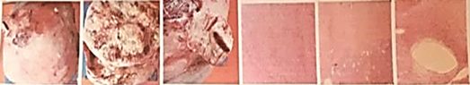 Estudio anatomopatológico de la
escisión del tumor. Masa tumoral constituida por una proliferación de células
fusadas de 
carácter muscular liso, sin presencia de atipia ni actividad mitótica indebida,
variantes morfológicas diversas; áreas de degeneración 
roja, hidrópica y amplias áreas quísticas.