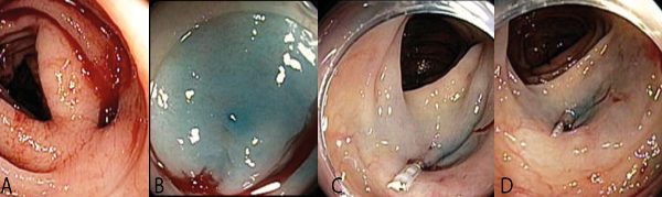 A) Diverticulo de colon con
sangrado activo B) Marcacion con infiltración submucosa de azul de metileno C)
Ingreso con 
capuchon y aplicación de endoclip D) Hemostasia posterior a terapia combinada
adrenalina, clip, irrigación con ácido tranexámico