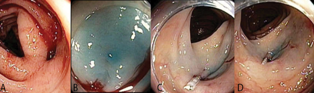 Gross image
of leiomyoma