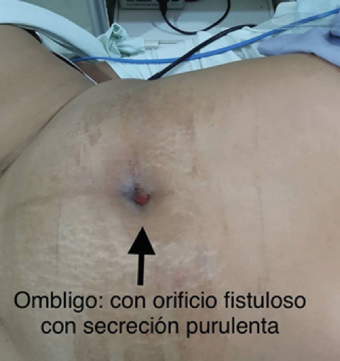 Fistula in
the umbilicus, with outflow of purulent material from urachal tumor.