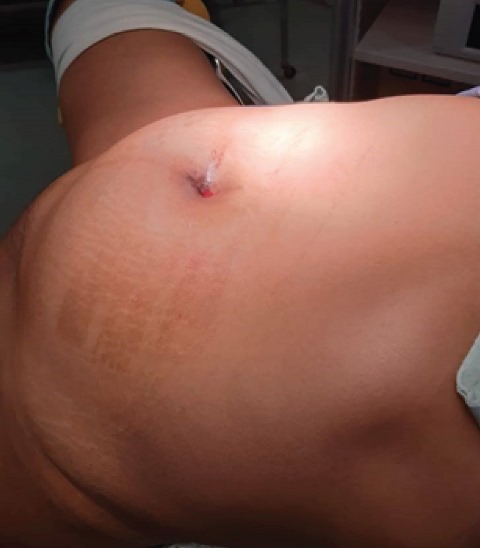 Patient
position, in forced trendelemburg at 45º, 4 trocars were placed, with the leg
in abduction.