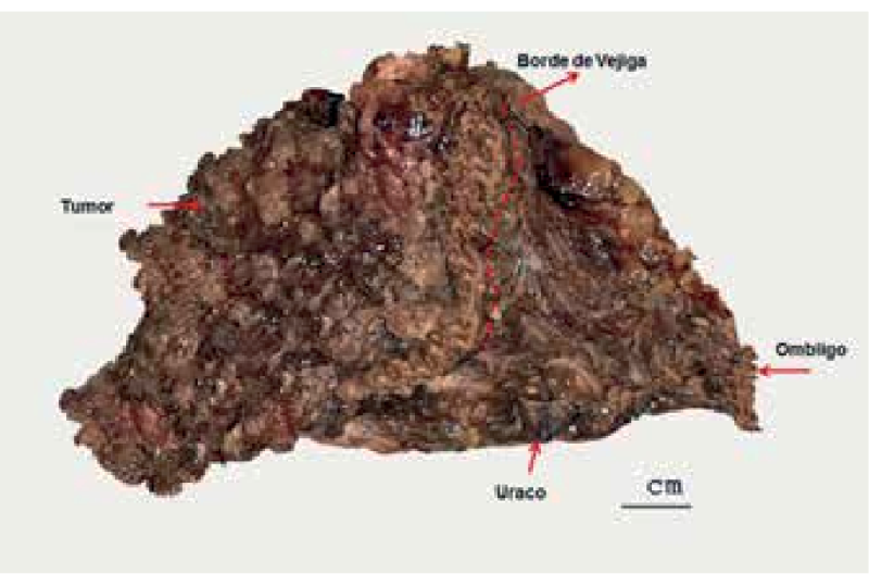 Surgical
specimen, complete tumor, with free bladder border and tumor.