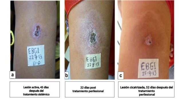 Seguimiento
clínico y evaluación del proceso de cicatrización post tratamiento.