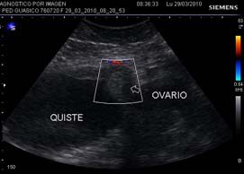 Ausencia de
flujo vascular en la pared del quiste para-ovárico y el ovario que fue
involucrado en la torsión de pedículo (torsión compleja).