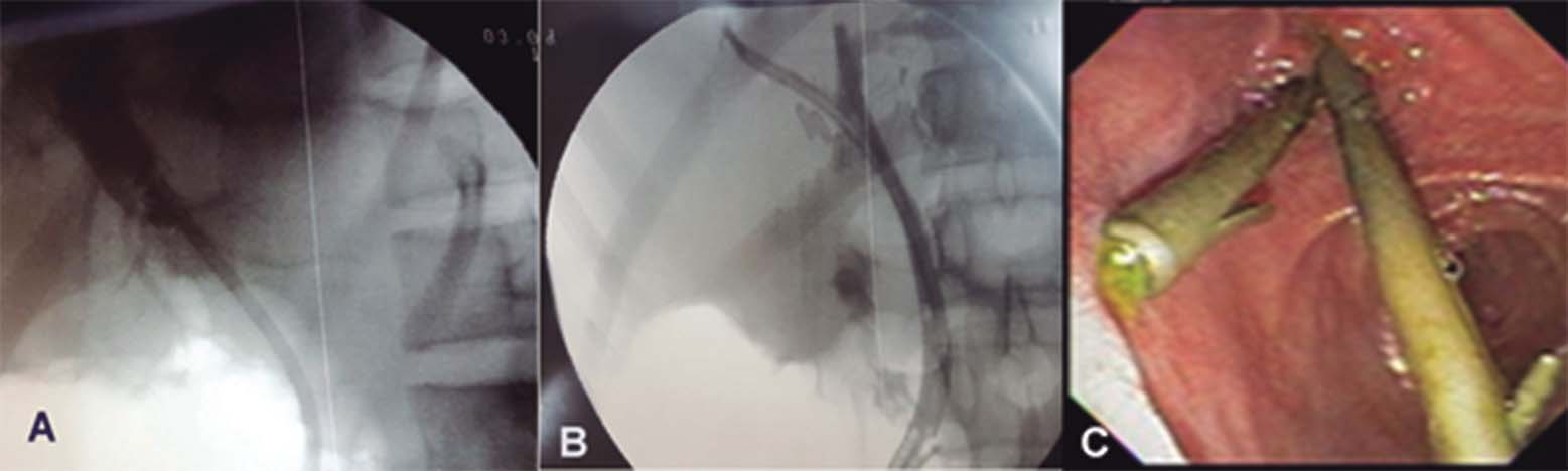 A) se observa colangiografia con
prótesis biliar de plastico insitu B) se observa colangiografia con dos
prótesis biliares de plástico C) se observan imagen endoscópica con las dos
prótesis biliares de plástico.