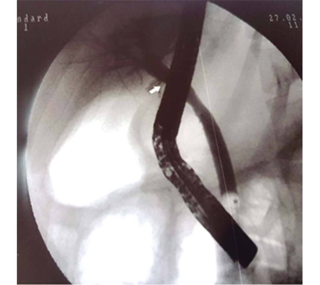 Colangiografia posterior a la
extracción de las prótesis de plástico se observa a nivel de fecha blanca
conducto hepático común con buen diámetro en zona de estenosis previa.
