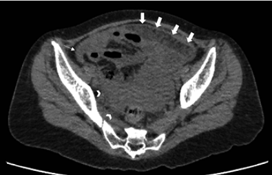 Figura 2. Tomografía simple abdominopélvica,
en corte axial a nivel de la pelvis, donde se evidenció engrosamiento del
peritoneo parietal y visceral “en sábana” (fechas gruesas), líquido libre en
goteras parietocólicas de leve cuantía (flecha fina) y en cavidad pélvica en
moderada cuantía (puntas de flecha).