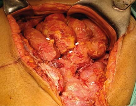Figura 3. Imagen transquirúrgico de la cavidad
abdominal, donde se evidencia nódulos de aspecto caseoso distribuidos en
peritoneo parietal, mesenterio (fechas gruesas) y tejido blanco nacarado
(flechas finas).