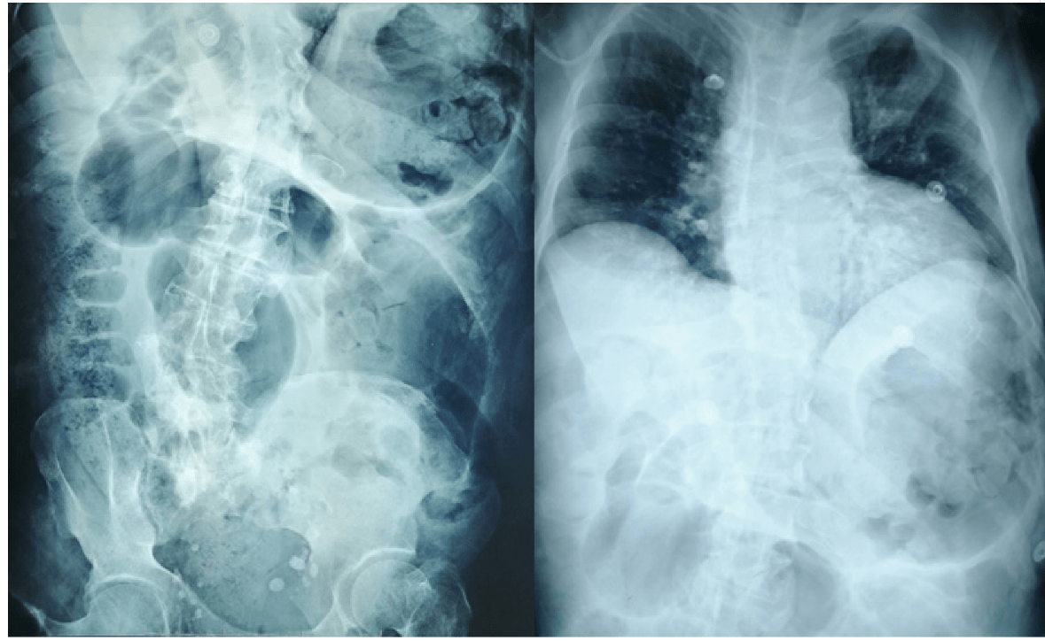  Serie abdominal presenta asas intestinales distendidas con nivel hidroa&eacute;reo sin gas distal