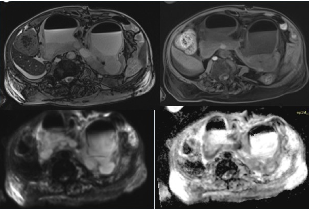 Resonancia magn&eacute;tica abdominal