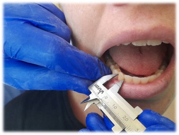 Medición directa del ancho mesiodistal del canino
inferior derecho