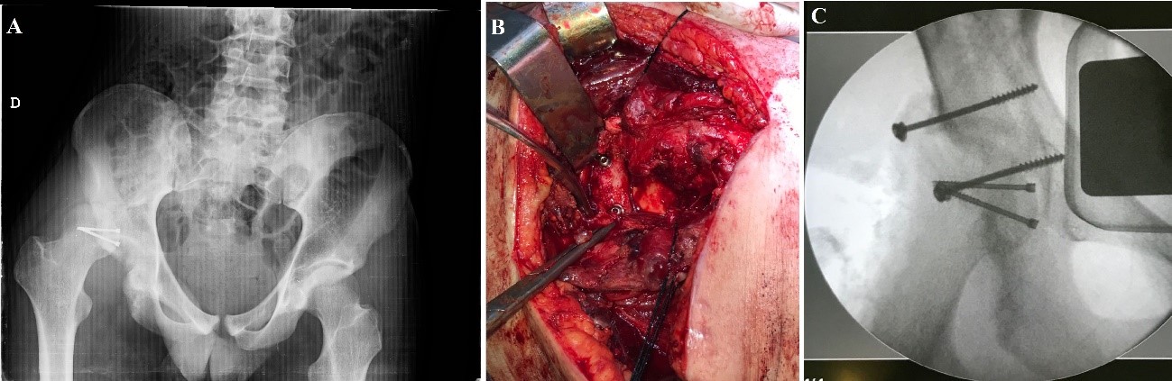 Episode of recurrent right hip dislocation after 1
month of the procedure. Radiograph depicts posterior right hip dislocation
without displacement of femoral head fracture (A). Intraoperative image that
illustrates fixation of iliac crest strut as posterior bone block by 2
cannulated screws (B). Final intraoperative radiograph with the bone graft
fixed in the proper place (C).