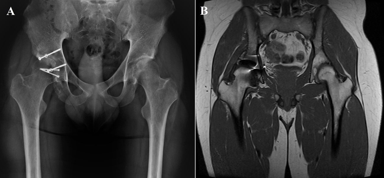 Final result in 2-year follow-up visit. Pelvic AP radiograph
represents the graft persists in place and there is no signs of degenerative
hip joint or avascular necrosis (A). Coronal slice MRI that demonstrates
absence of avascular necrosis (B).