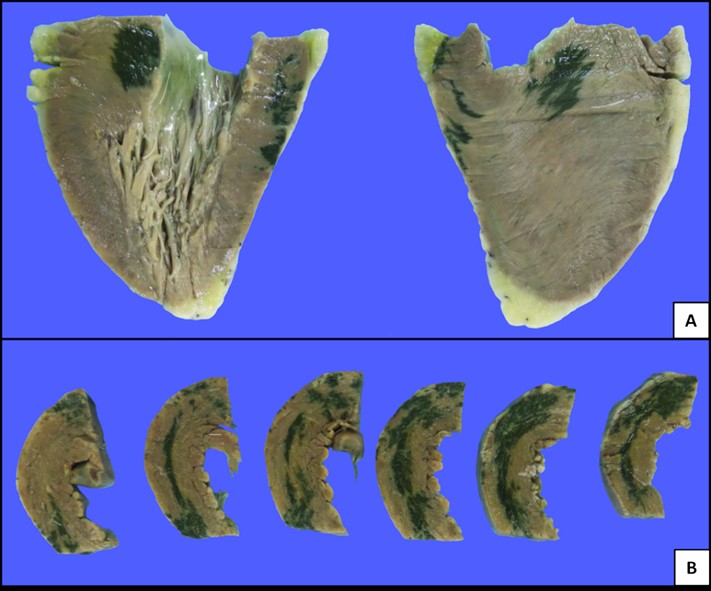 Aspecto macroscópico del infarto de miocardio secundario a hipotensión arterial.