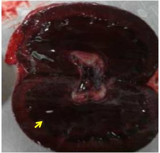 Longitudinal section of the kidney. Severe
  cortico-medullary congestion