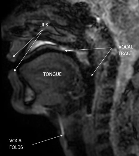 Magnetic
Resonance Image (MRI) done by the authors with annotated anatomy of the vocal
tract