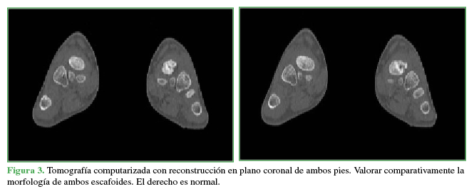 Tomografía computarizada con reconstrucción en plano coronal de ambos pies.