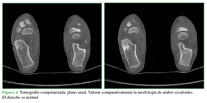 Tomografía computarizada, plano axial. Valorar comparativamente la morfología de ambos escafoides. El derecho es normal.