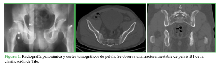 Radiografía panorámica y cortes tomográficos de pelvis. Se observa una fractura inestable de pelvis B1 de la clasificación de Tile 