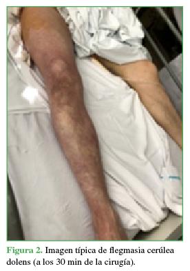 Imagen típica de flegmasia cerúlea dolens (a los 30 min de la cirugía)
