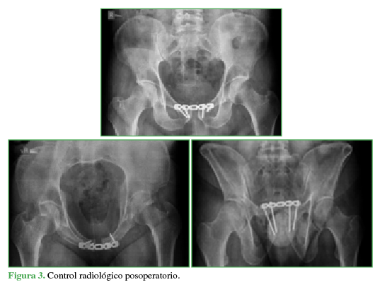 Control radiológico postoperatorio