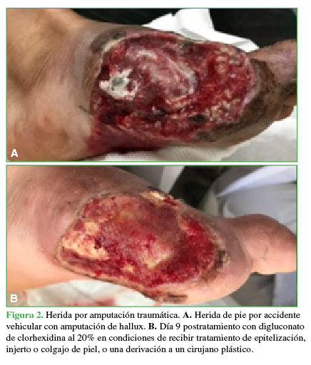 Herida por amputación traumática