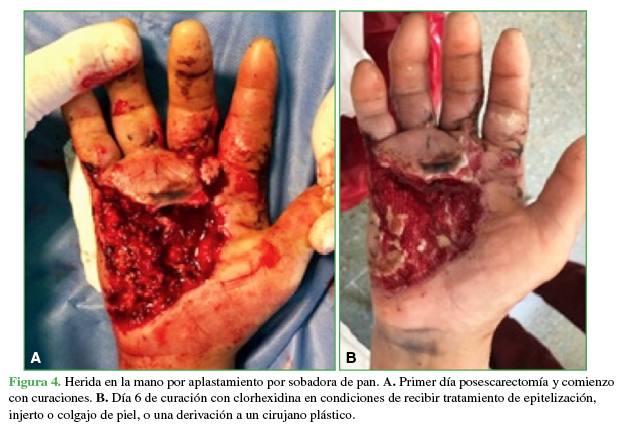 Herida en la mano por aplastamiento por sobadora de pan.