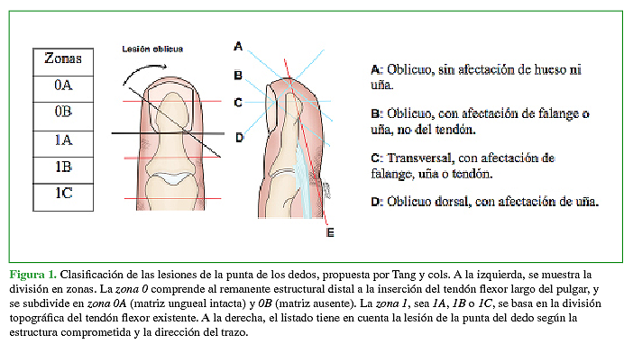 Clasificación de las lesiones de la punta de los dedos, propuesta por Tang y cols.7