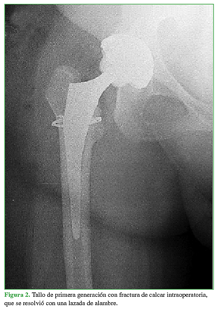 Tallo de primera generación con fractura de calcar intraoperatoria,que se resolvió con una lazada de alambre.