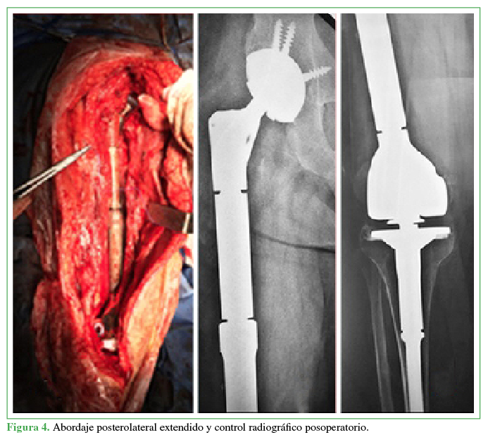 Abordaje posterolateral extendido y control radiográfico posoperatorio. 