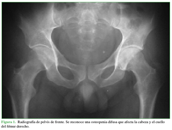 Radiografía de pelvis de frente. Se reconoce una osteopenia difusa que afecta la cabeza y el cuello del fémur derecho.