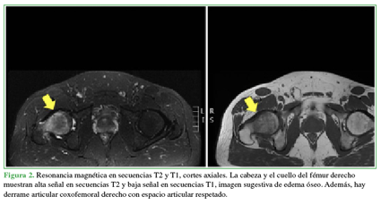 Resonancia magnética en secuencias T2 y T1, cortes axiales. La cabeza y el cuello del fémur derecho muestran alta señal en secuencias T2 y baja señal en secuencias T1, imagen sugestiva de edema óseo. Además, hay derrame coxofemoral derecho con espacio articular respetado.