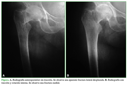 A. Radiografía anteroposterior sin tracción. Se observa una aparente fractura lateral desplazada. B. Radiografía con tracción y rotación interna. Se observa una fractura medial.