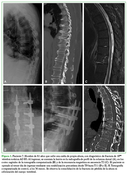 Paciente 7. Hombre de 81 años que sufre una caída de propia altura, con diagnóstico de fractura de 10ma vértebra torácica AO B3. Al ingresar, se constata la lesión en la radiografía de perfil de la columna dorsal (A), en los cortes sagitales de la tomografía computarizada (B) y de la resonancia magnética en secuencia T2 (C). El paciente es operado al tercer día de ingresar mediante una estabilización percutánea desde T9 hasta T11 (D y E). F. Tomografía computarizada de control, a los 36 meses. Se observa la consolidación de la fractura sin pérdida de la altura ni cifotización del cuerpo vertebral.