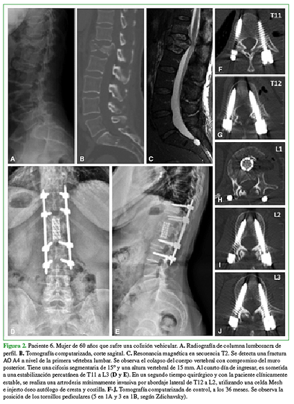 Paciente 6. Mujer de 60 años que sufre una colisión vehicular. A. Radiografía de columna lumbosacra de perfil. B. Tomografía computarizada, corte sagital. C. Resonancia magnética en secuencia T2. Se detecta una fractura AO A4 a nivel de la primera vértebra lumbar. Se observa el colapso del cuerpo vertebral con compromiso del muro posterior. Tiene una cifosis segmentaria de 15º y una altura vertebral de 15mm. Al cuarto día de ingresar, es sometida a una estabilización percutánea de T11 a L3 (D y E). En un segundo tiempo quirúrgico y con la paciente clínicamente estable, se realiza una artrodesis mínimamente invasiva por abordaje lateral de T12 a L2, utilizando una celda Mesh e injerto óseo autólogo de cresta y costilla. F-J. Tomografía computarizada de control, a los 36 meses. Se observa la posición de los tornillos pediculares (5 en 1A y 3 en 1B, según Zdichavsky). 