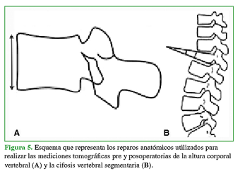 Esquema que representa los reparos anatómicos utilizados para realizar las mediciones tomográficas pre y posoperatorias de la altura corporal vertebral (A) y la cifosis vertebral segmentaria (B). 