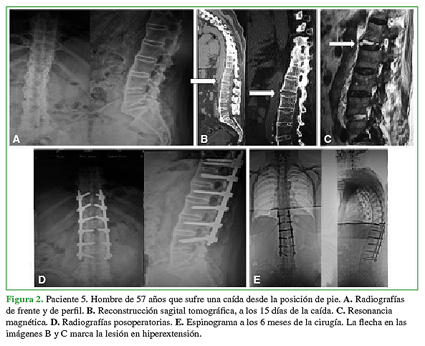 Paciente 5. Hombre de 57 años que sufre una caída desde la posición de pie. A. Radiografías de frente y de perfil. B. Reconstrucción sagital tomográfica, a los 15 días de la caída. C. Resonancia magnética. D. Radiografías posoperatorias. E. Espinograma a los 6 meses de la cirugía. La flecha en las imágenes B y C marca la lesión en hiperextensión.