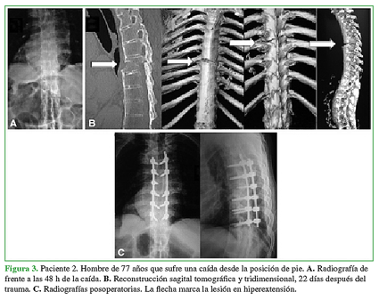 Paciente 2. Hombre de 77 años que sufre una caída desde la posición de pie. A. Radiografía de frente a las 48 h de la caída. B. Reconstrucción sagital tomográfica y tridimensional, 22 días después del trauma. C. Radiografías posoperatorias. La flecha marca la lesión en hiperextensión.