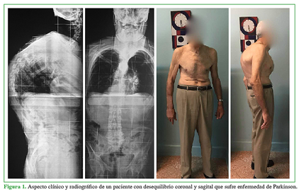 Aspecto clínico y radiográfico de un paciente con desequilibrio coronal y sagital que sufre enfermedad de Parkinson.