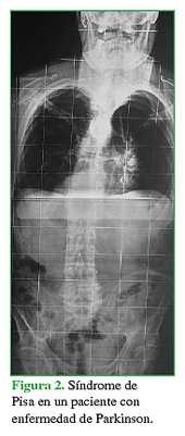 Síndrome de Pisa en un paciente con enfermedad de Parkinson.