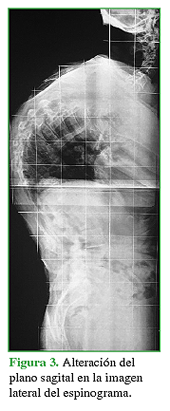 Alteración del plano sagital en la imagen lateral del espinograma.