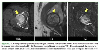 A. Tomografía computarizada con imagen lineal en forma de semiluna a nivel subcondral delimitando la zona de necrosis avascular. B y C. Resonancia magnética en secuencias T2 y T1, corte sagital. Se observa la misma imagen lineal en la cabeza femoral derecha que muestra aumento de señal y se acompaña de edema óseo.   