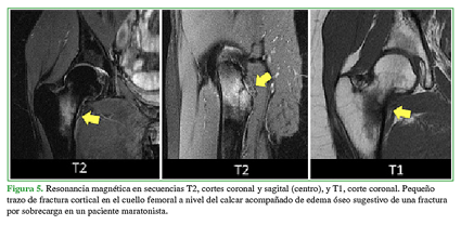 Resonancia magnética en secuencias T2, cortes coronal y sagital (centro), y T1, corte coronal. Pequeño trazo de fractura cortical en el cuello femoral a nivel del calcar acompañado de edema óseo sugestivo de una fractura por sobrecarga en un paciente maratonista.